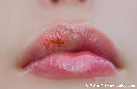 初早期女性单纯疱疹图片与症状图片，生殖器疱疹和口腔疱疹(并发症很可怕)