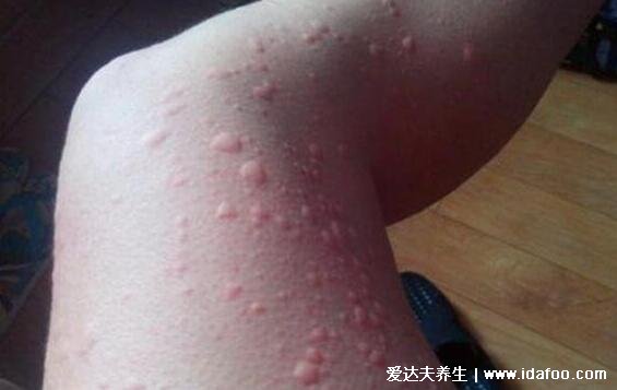 真实女性皮肤过敏图片症状，荨麻疹或过敏性皮炎都会长红疙瘩
