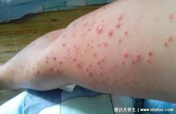 艾滋病最初皮疹图片症状图片,手脚胸背可出现深红色隆起疹子