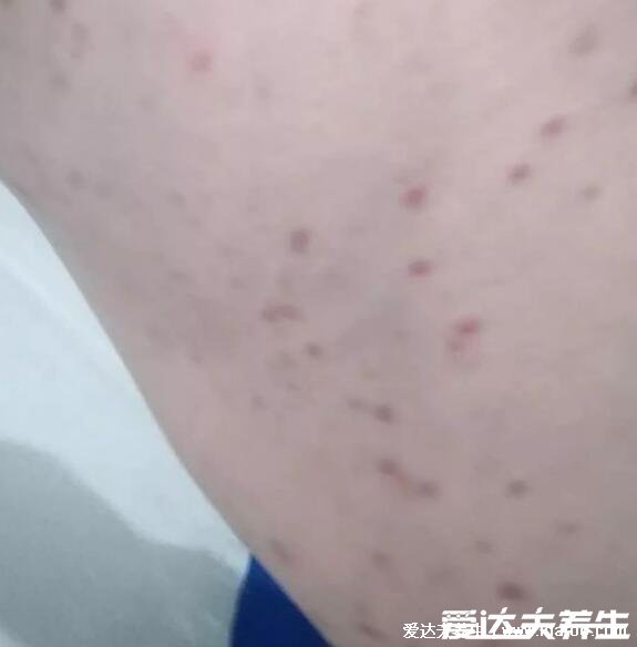 艾滋病最初皮疹图片症状图片,手脚胸背可出现深红色隆起疹子