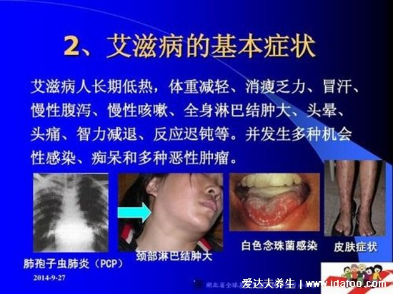 艾滋病最初皮疹图片症状图片,手脚胸背可出现深红色隆起疹子