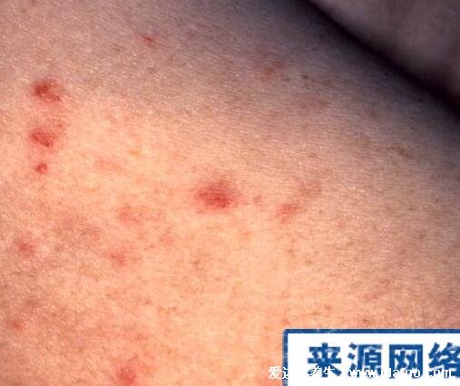 艾滋病最初皮疹图片症状图片,手脚胸背可出现深红色隆起疹子