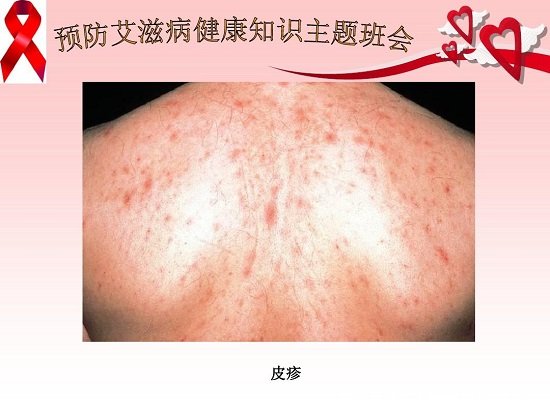 艾滋病最初皮疹图片症状图片,手脚胸背可出现深红色隆起疹子