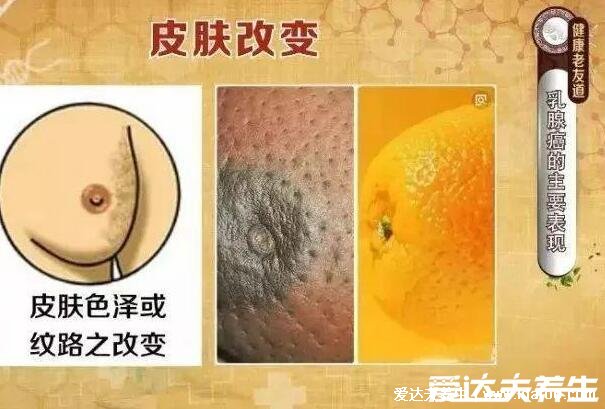 女性乳腺癌图片早期症状,乳头表面出现溢液要注意(乳房肿块4大症状)