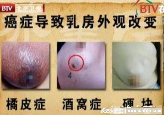 女性乳腺癌图片早期症状,乳头表面出现溢液要注意(乳房肿块4大症状)