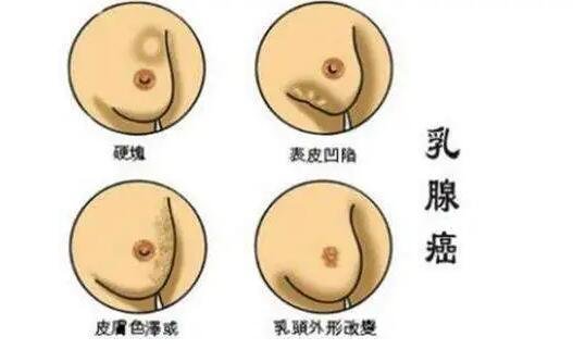 女性乳腺癌图片早期症状,乳头表面出现溢液要注意(乳房肿块4大症状)
