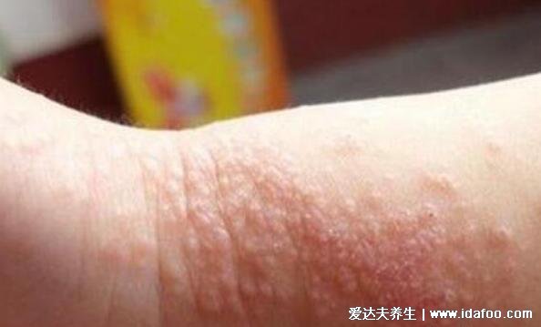 红色斑丘疹的图片是什么病,过敏性湿疹有红斑丘疹伴随剧烈瘙痒