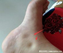 脚肿是什么病的前兆,缺乏维生素B1导致的脚