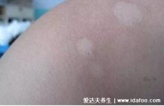 早期花斑癣图片及症状，白色或黄褐色斑点