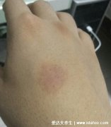 正常皮下出血点图片，注意紫癜和淤青的区