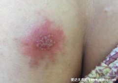 初早期女性单纯疱疹图片与症状图片，生殖