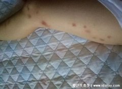 坏死性筋膜炎图片早期症状，皮肤红肿疼痛