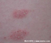 玫瑰糠疹图片初期症状，1到3厘米淡红色斑有