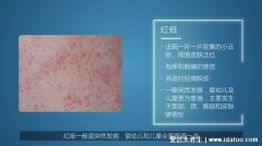 婴儿脸上热痱子的症状图片,红痱感觉痒痛