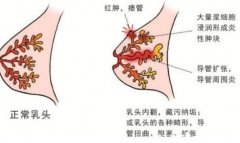 乳腺炎的症状表现有哪些症状图片，哺乳期