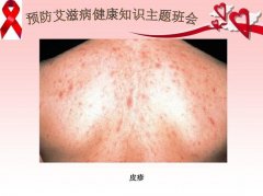 艾滋病最初皮疹图片症状图片，手脚胸背可