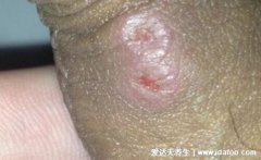 初期男女性梅毒疹图片及症状,全身多处长