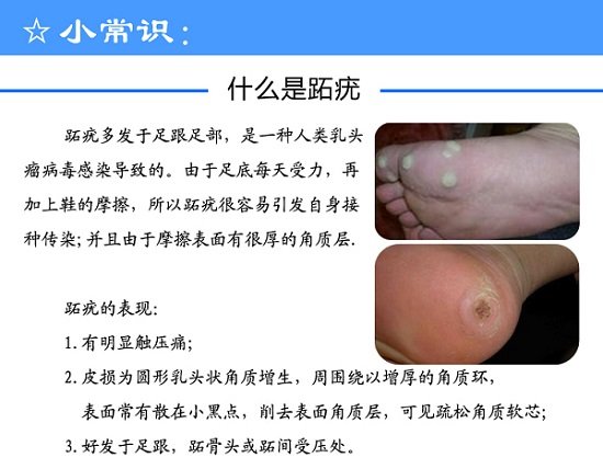 趾疣症状图片是什么样子，初期细小发亮丘疹(到后面有粗糙角质)