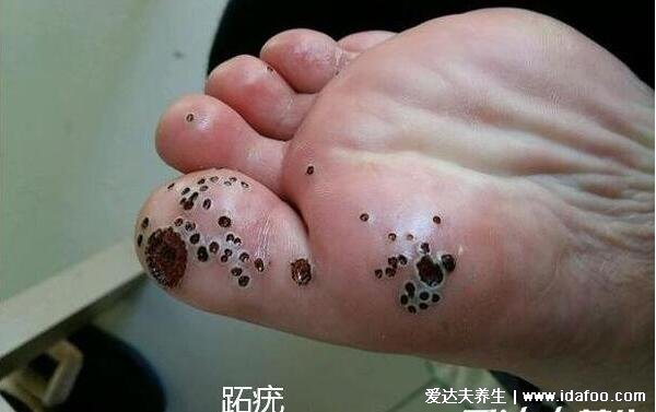 趾疣症状图片是什么样子，初期细小发亮丘疹(到后面有粗糙角质)