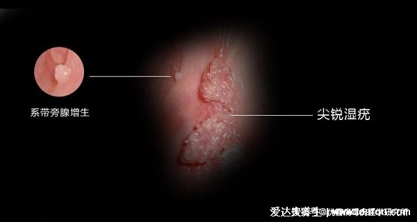 男女性尖疣湿早期症状图片,在初期出现淡红色丘疹(可呈鸡冠菜花状)