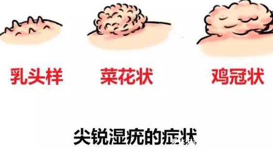 男女性尖疣湿早期症状图片,在初期出现淡红色丘疹(可呈鸡冠菜花状)