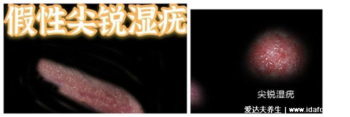 男女性尖疣湿早期症状图片,在初期出现淡红色丘疹(可呈鸡冠菜花状)