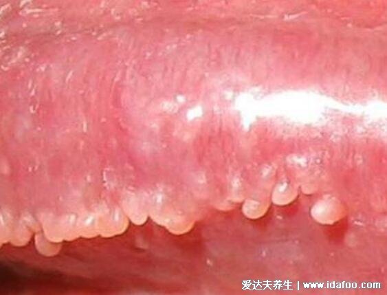 男女性尖疣湿早期症状图片,在初期出现淡红色丘疹(可呈鸡冠菜花状)