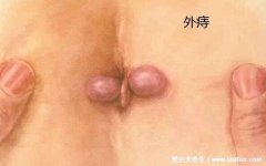 真实的外痔疮图片长什么样?能摸到肛门口有