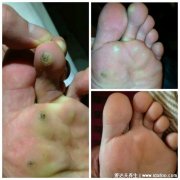 趾疣症状图片是什么样子，初期细小发亮丘