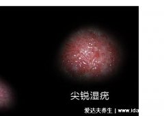 男女性尖疣湿早期症状图片,在初期出现淡