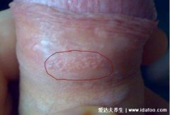 阴囊湿疹图片初期症状大全,有红斑磷屑伴