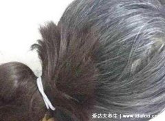 叶酸片能治白头发吗,不能但缺乏叶酸毛发