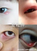 麦粒肿早期图片，会出现红肿热痛(包括内麦