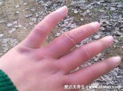 冻疮图片长什么样子，刚开始有紫红色肿块