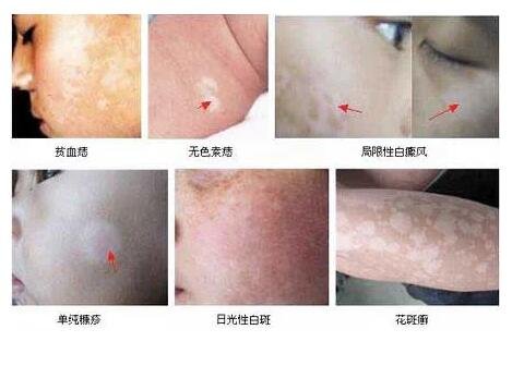 刚长出来的白斑图片,白癜风没鳞屑边界清楚(白斑可对应5种疾病)