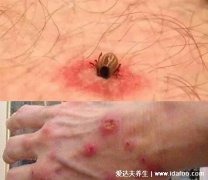 蜱虫咬人后的伤口图,会出现红肿发热现象