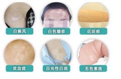 刚长出来的白斑图片，白癜风没鳞屑边界清