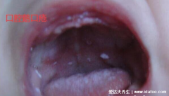 婴儿鹅口疮的图片早期症状，长在口腔的白