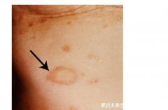 玫瑰糠疹初期症状图片,淡红斑有鳞屑可瘙