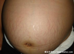 真实妊娠纹图片，看完又是恐婚的一天(妊娠