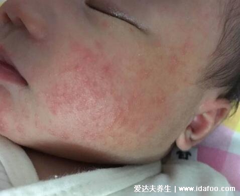 皮炎和湿疹区别图片,湿疹可发于成人头部四肢(100种皮肤病对照图片)