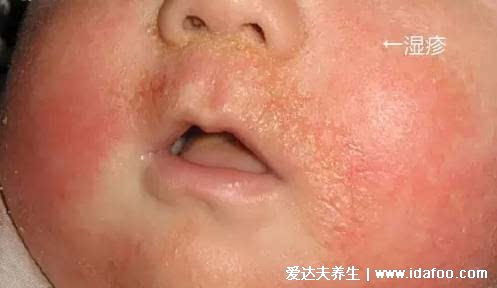皮炎和湿疹区别图片,湿疹可发于成人头部四肢(100种皮肤病对照图片)