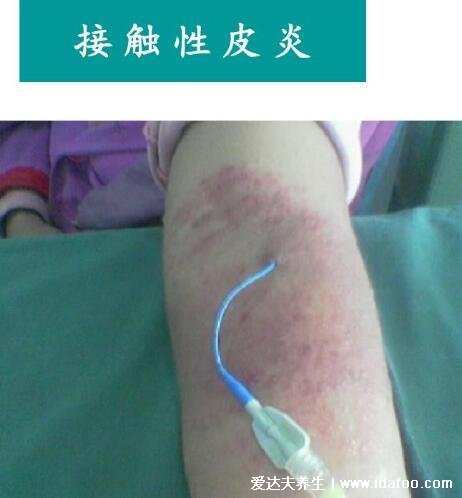 皮炎和湿疹区别图片,湿疹可发于成人头部四肢(100种皮肤病对照图片)