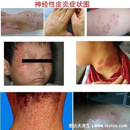 皮炎和湿疹区别图片,湿疹可发于成人头部四肢(100种皮肤病对照图片)