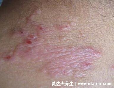 皮炎和湿疹区别图片,湿疹可发于成人头部四肢(100种皮肤病对照图片)