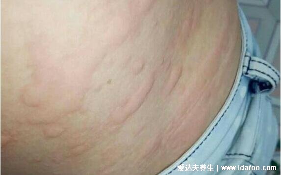 皮炎和湿疹区别图片,湿疹可发于成人头部四肢(100种皮肤病对照图片)