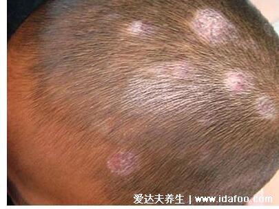 皮炎和湿疹区别图片,湿疹可发于成人头部四肢(100种皮肤病对照图片)
