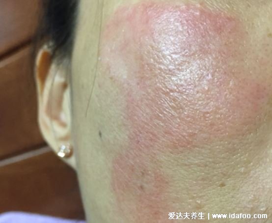 皮炎和湿疹区别图片,湿疹可发于成人头部四肢(100种皮肤病对照图片)