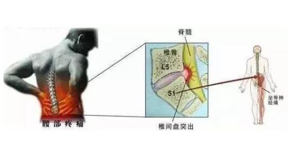 坐骨神经痛的疼点图,多是腰突导致且臀腿一侧疼(附正确睡姿图)