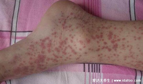 紫癜初期的图片及症状大全,按压不褪色的小红点会反复发作